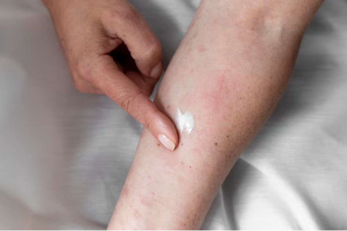 Dermatite atópica passa a ter tratamento mais completo pelo SUS